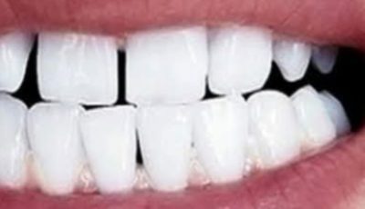 Remove Tartar and Whiten Your Teeth Naturally with Sage Leaves