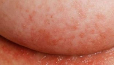 An itchy rash keeps flaring up under my breasts in winter, but my doctor isn’t available right now. What can I do today?