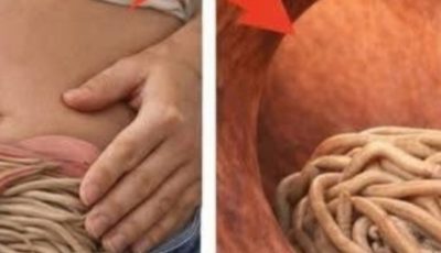 Garlic eliminates parasites in just 1 day? What you really should know before trying it